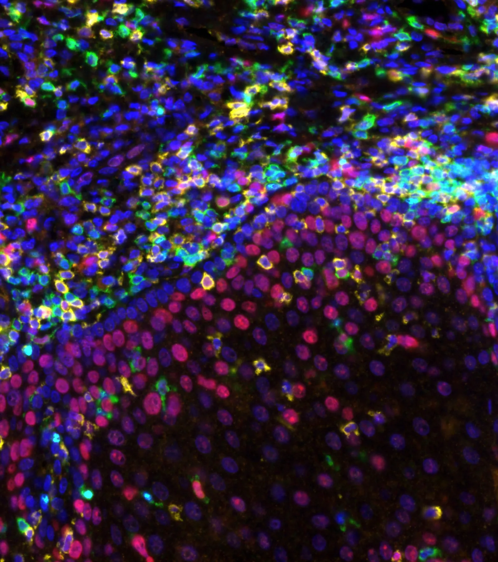 Linfócitos T em um tumor, em microscopia