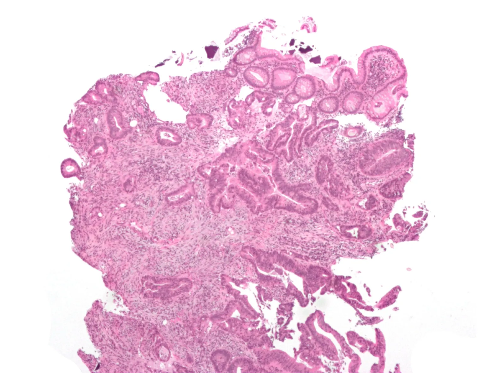 Peça cirúrgica de intestino grosso com adenocarcinoma no ceco